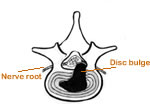 thumbnail image link to causes of sciatica page