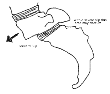 image of spondylolisthesis showing a slip of one vertebrae on another