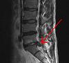 surgery for sciatica